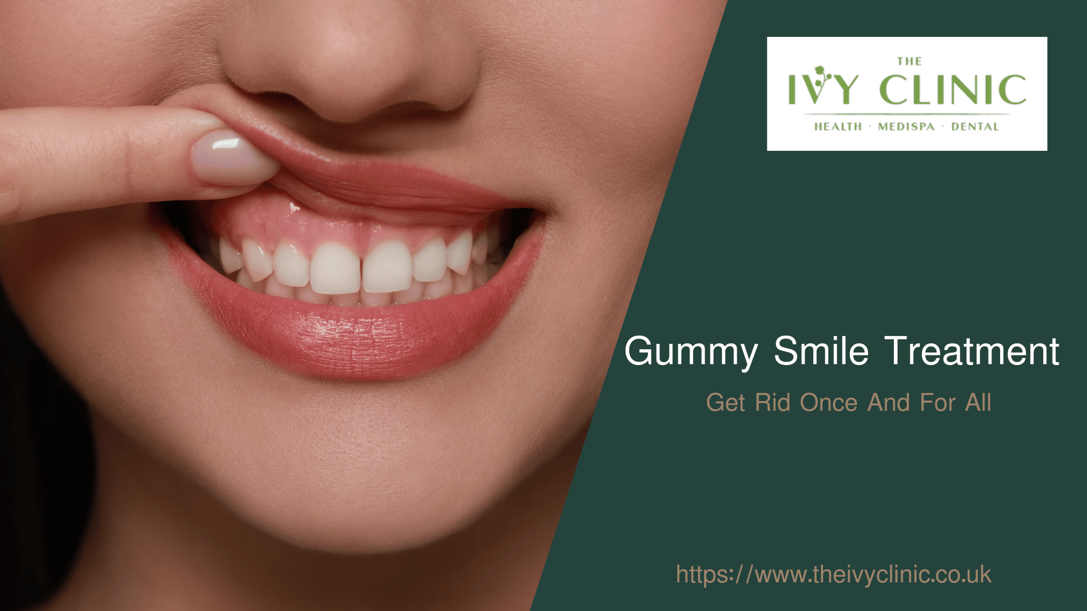 Gummy Smile Treatment – Get Rid Once And For All